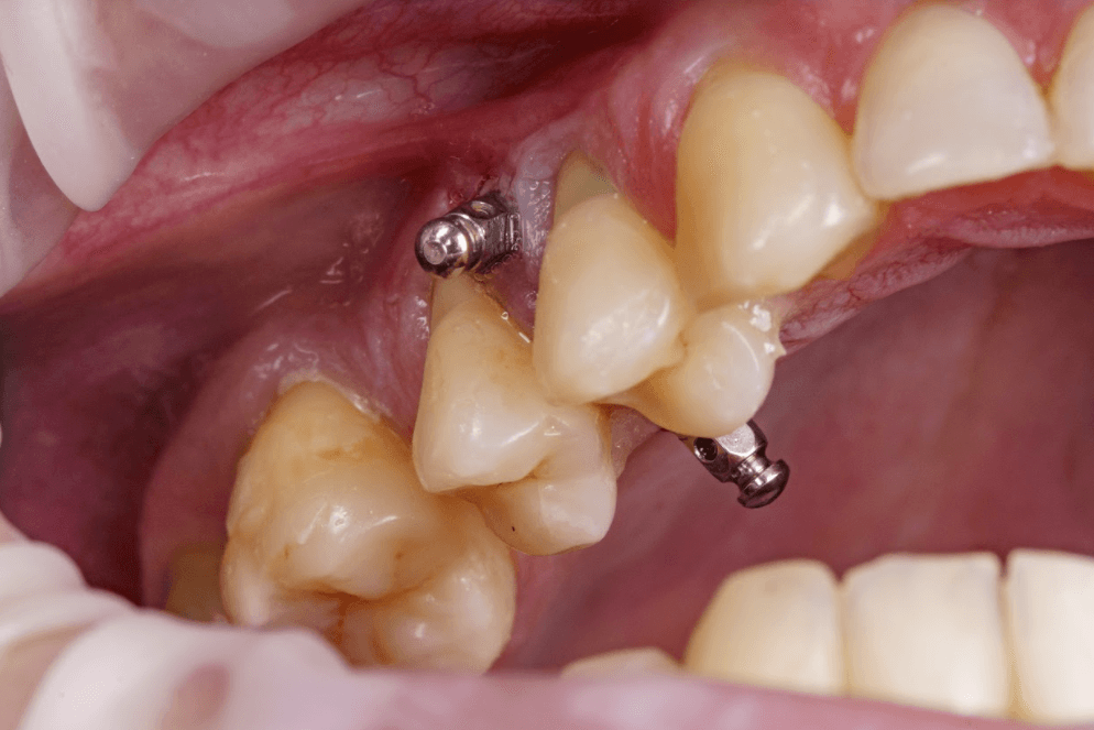 Microimplantes en Ortodoncia Lingual: Avances y Beneficios.